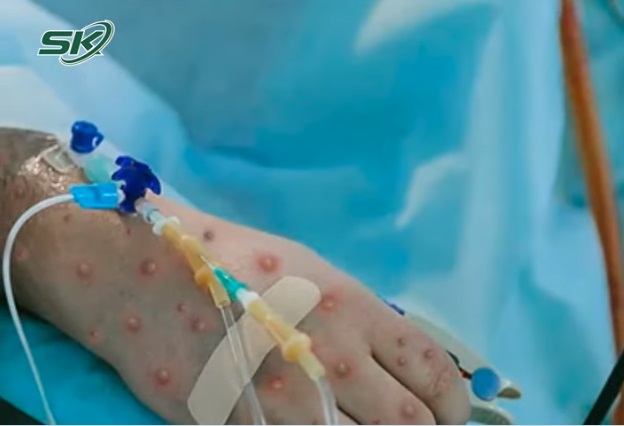 Sáng 6/10: Đoàn công tác Bộ Y tế kiểm tra, giám sát bệnh đậu mùa khỉ tại TP HCM - Ảnh 1.