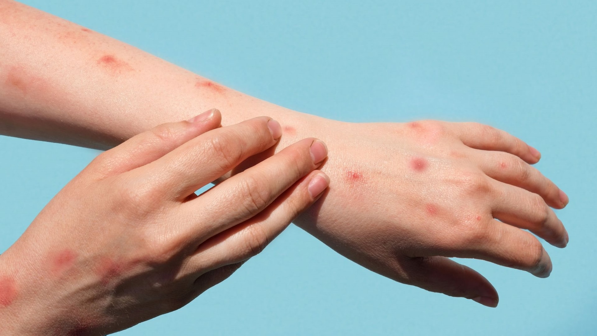 skynews-monkeypox-patient-hands_5952558.jpeg