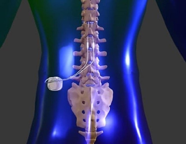 Bệnh nhân chi tiền 'khủng' dùng xung điện điều trị đau nửa người ảnh 1