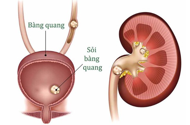 Nhận biết triệu chứng bị sỏi bàng quang và cách điều trị - Ảnh 1.