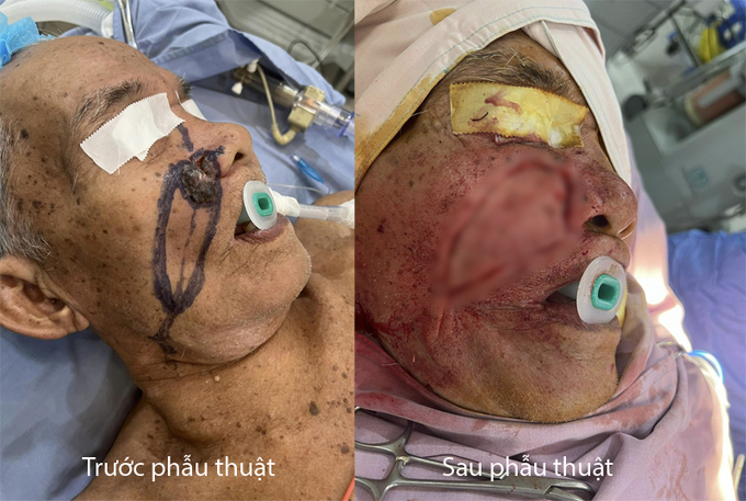 Hình ảnh trước và sau  phẫu thuật của bệnh nhân T., tại Bệnh viện ĐK Thống Nhất