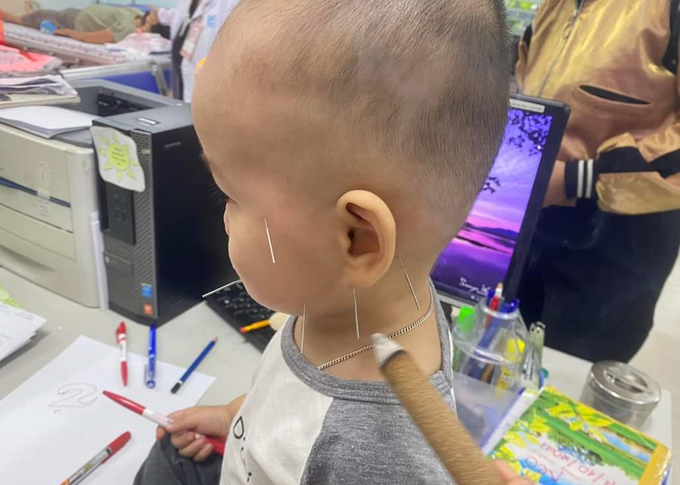 Kết hợp phương pháp châm cứu điều trị cho bệnh nhân là trẻ nhỏ