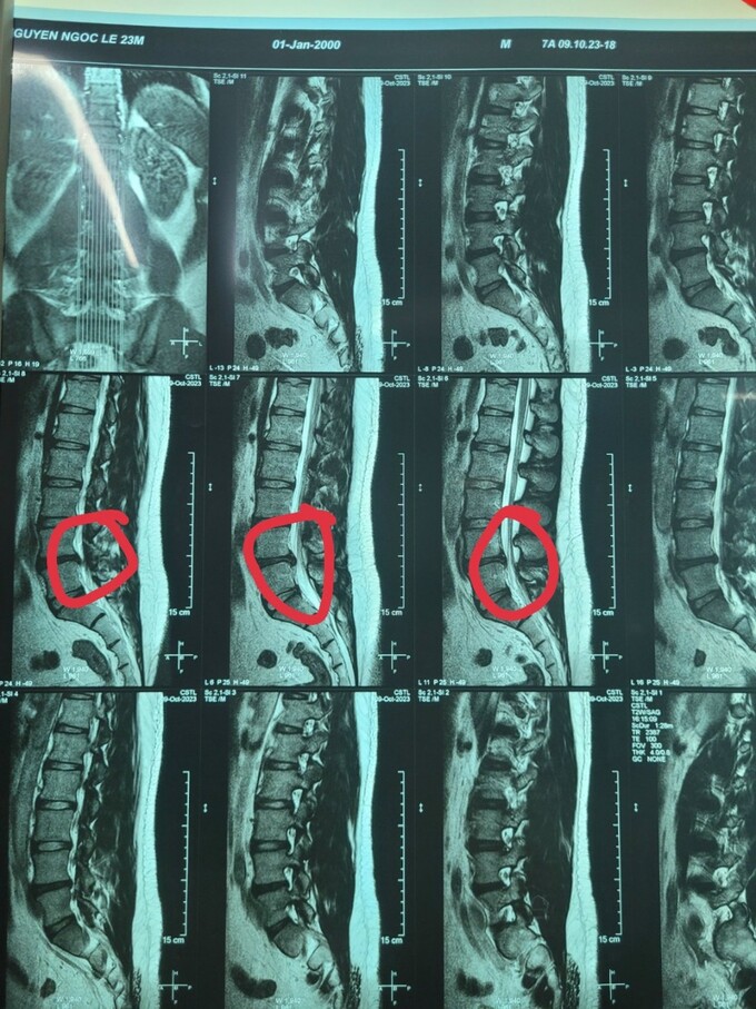 Khối thoát vị chèn rễ thần kinh của bệnh nhân 20 tuổi (Ảnh: BSCC)