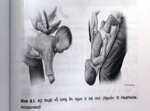 Kỹ thuật vỗ lưng - ấn ngực ở trẻ nhỏ