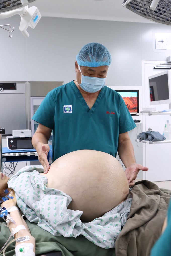 Khối u khổng lồ nặng 20 kg khiến bụng của bệnh nhân phình to