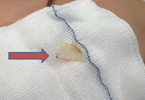 Dị vật là mảnh xương cá kích thước 1,5×2,5 cm