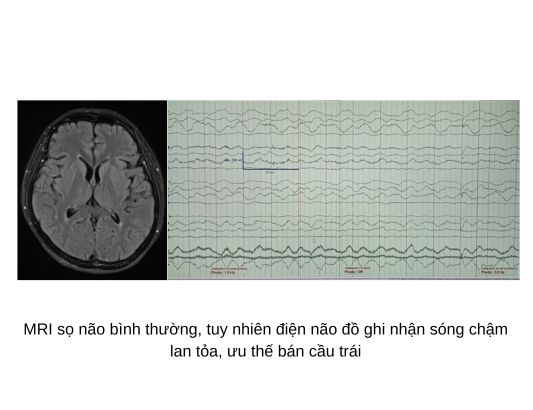 MRI sọ não