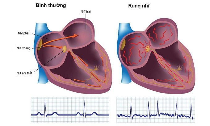 Người cao tuổi cần tầm soát thường xuyên để phát hiện sớm bệnh rung nhĩ (ảnh minh họa)