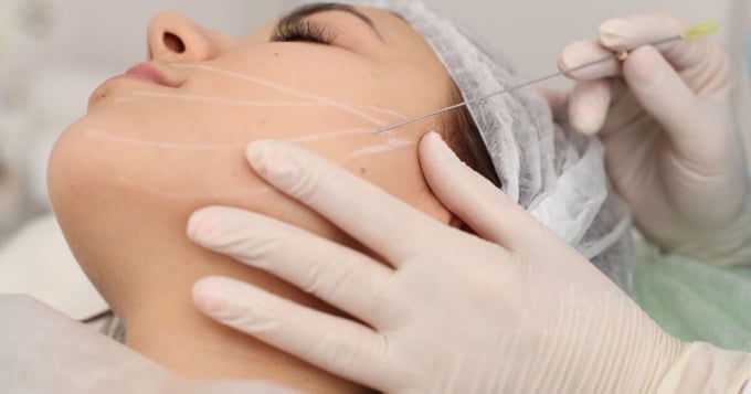 Một phụ nữ 70 tuổi tử vong sau phẫu thuật căng da mặt (Ảnh minh hoạ)