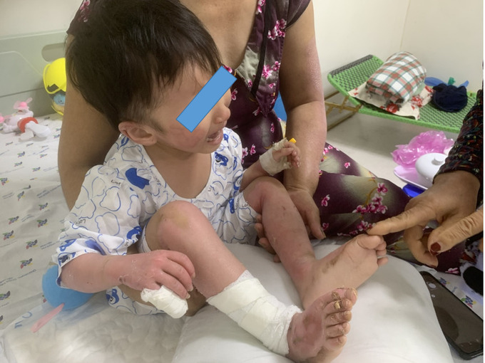 Sau 10 ngày điều trị bé  L. K. H. M đã phục hồi dần