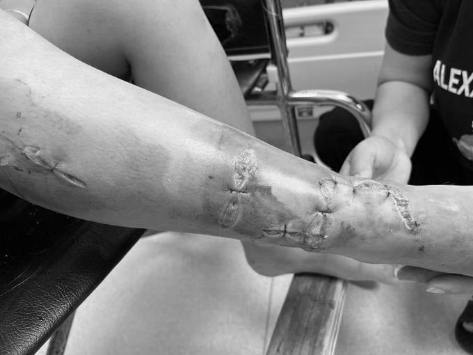 Bệnh nhi bị kiếng vỡ của lọc tràn hồ cá kiểng cắt đứt mạch máu, thần kinh, gân chân phải, được cấp cứu kịp thời phục hồi chức năng