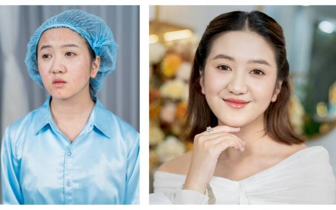Ngắm nhìn nhan sắc của Hảo Vi trước và sau khi điều trị mụn tại Viện Thẩm mỹ DIVA