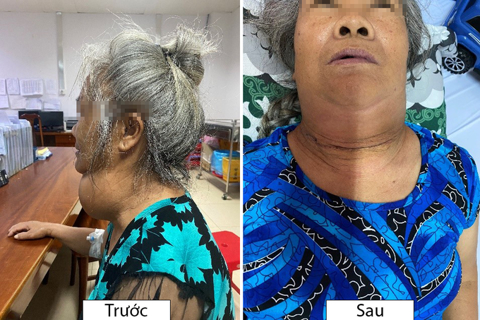 Hình ảnh bệnh nhân trước và sau khi phẫu thuật cắt bỏ bướu tuyến giáp khổng lồ