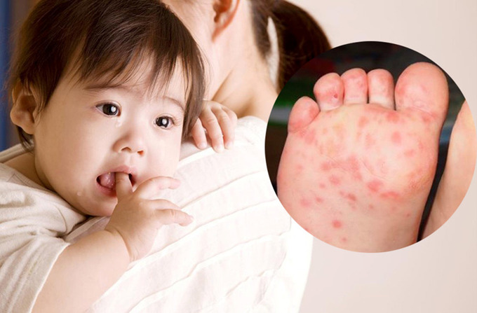 Chú ý phòng bệnh mùa nắng nóng cho trẻ (ảnh minh họa)