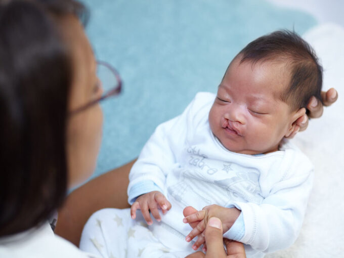 Phẫu thuật miễn phí khe hở môi, hàm ếch (ảnh minh họa)