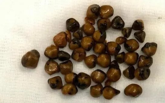  Hơn 40 viên sỏi kích thước từ 4 - 12 mm của bệnh nhân