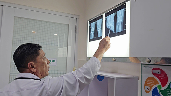 Qua thăm khám và thực hiện các cận lâm sàng cần thiết, người bệnh được chẩn đoán thoái hoá khớp gối phải độ 4