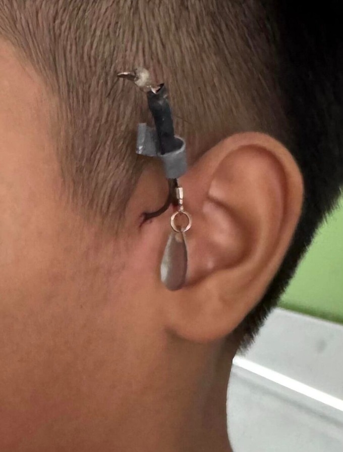 Bé trai bị dị vật móc câu đâm vào trước tai