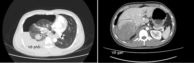 Kết quả chụp CT scanner phổi, gan của bệnh nhân P. (Ảnh: BVCC)