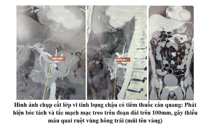 Cuu-thanh-cong-ca-dau-bung-cap-hiem-gap-do-boc-tach-dong-mach-mac-treo-trang-tren-1