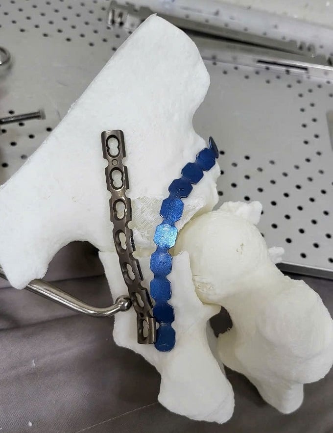 Công nghệ in 3D giúp tạo ra các mô hình chính xác của cấu trúc xương, từ đó tối ưu hóa kế hoạch phẫu thuật (Ảnh: BVCC)
