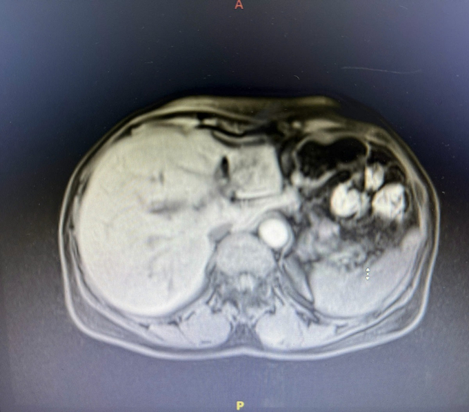 Hình ảnh CT vùng gan tổn thương (Ảnh: BVCC)