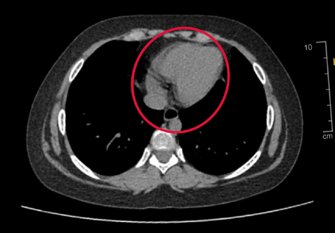 Hình ảnh u buồng trứng xoắn trên hình ảnh CTscan (Ảnh: BVCC)