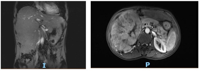 Hình ảnh khối u gan trên MRI của bệnh nhân N.V.S
