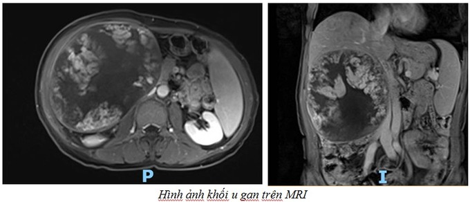 Hình ảnh khối u gan trên MRI của bệnh nhân T.V.U