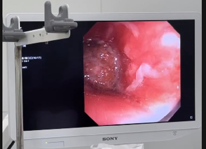 Chụp CT ngực cho thấy có dị vật nằm ở phế quản gốc trái của bệnh nhân (Ảnh: BVCC)