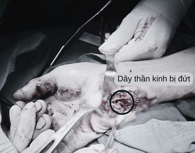 Tức giận, nam thanh niên đập tay vào kính, đứt gân cơ và bó mạch thần kinh cổ tay (Ảnh: BVCC)