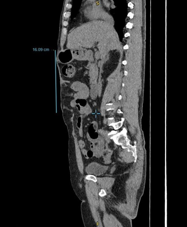 Hình ảnh CT khối thoát vị có đường kính hơn 16cm (Ảnh: BVCC)