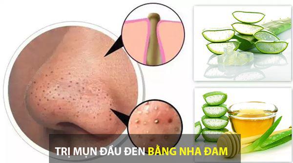 cach tri mun dau den tan goc tai nha nhanh va hieu qua nhat - 6