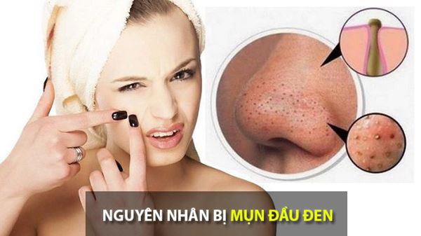 cach tri mun dau den tan goc tai nha nhanh va hieu qua nhat - 1