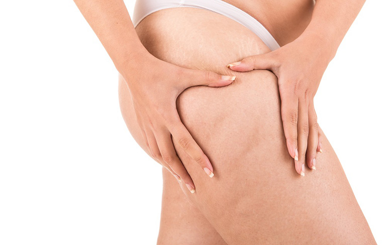Rạn da đùi - Nguyên nhân và cách khắc phục nhanh nhất