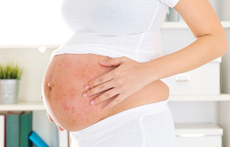 Bà bầu bị dị ứng thời tiết khi mang thai phải làm sao?
