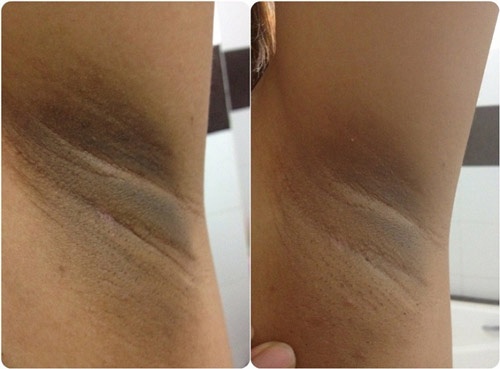 trị thâm nách sau sinh
