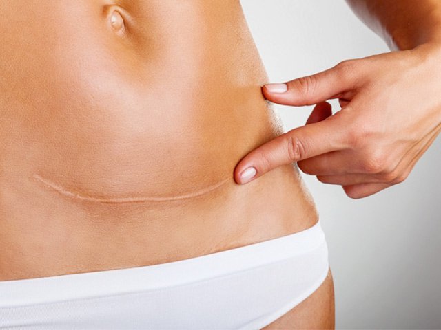 Sau sinh mổ bao lâu thì vết mổ sẽ lành? | Vinmec