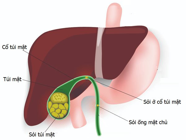 Sỏi túi mật