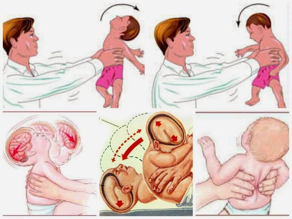 Rung lắc, tung hứng mạnh: Trẻ đối mặt với nguy cơ tổn thương não ...