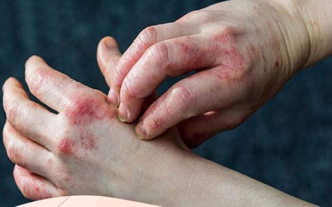Biến chứng của bệnh tiểu đường trên da (Ảnh minh họa)
