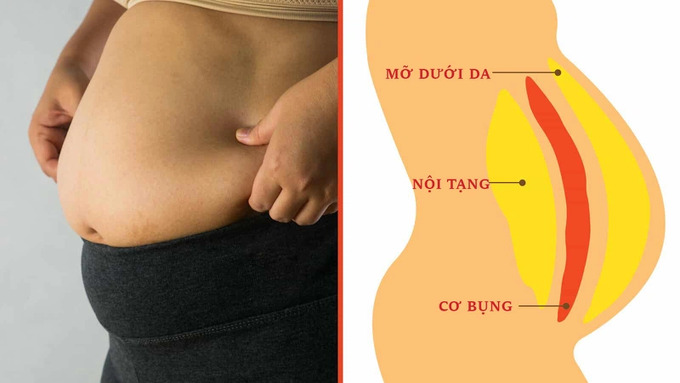 Hội chứng chuyển hóa là tình trạng cơ thể gặp nhiều vấn đề sức khỏe cùng lúc như vòng eo lớn, rối loạn lipid máu, tăng huyết áp và đường huyết cao (Ảnh minh họa)