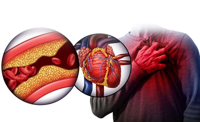 Rối loạn mỡ máu có thể gây ảnh hưởng đến tim mạch