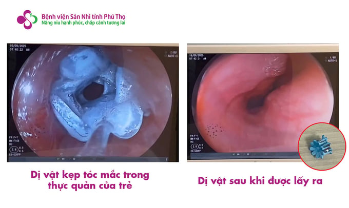Hình ảnh dị vật mắc trong thực quản và dị vật sau khi được lấy ra 