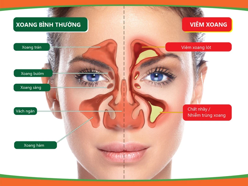 mach-ban-cach-tri-viem-xoang-sang-tai-nha-don-gian-va-hieu-qua-1-46d8bad3a9