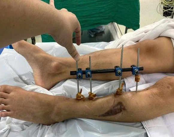 Bệnh nhân 20 tuổi bị khuyết hổng xương chày do viêm xương tủy trước khi phẫu thuật (Ảnh: Bệnh viện Quân Y 175)