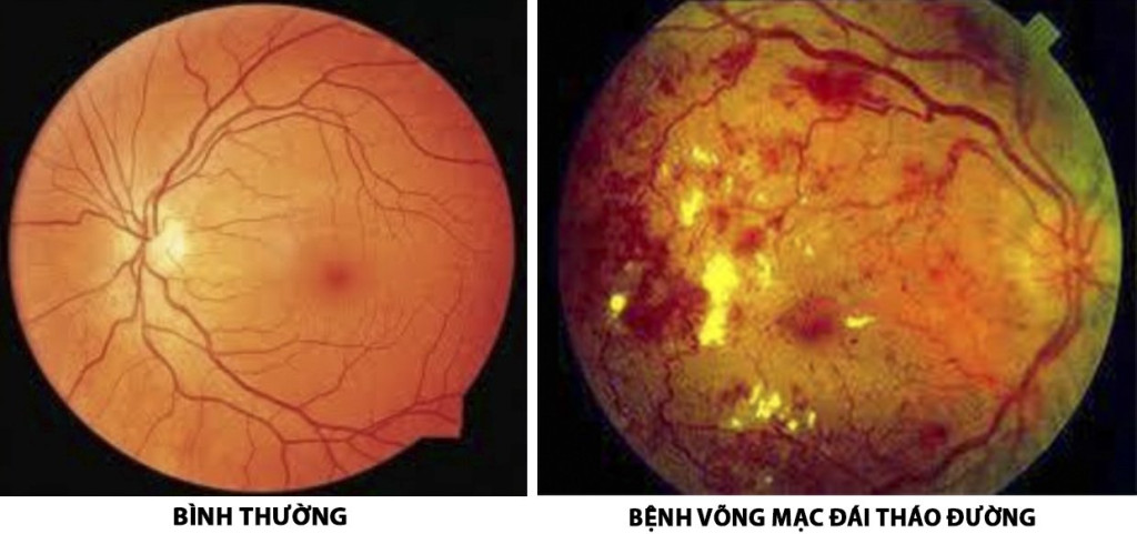 vong-mac-do-tieu-duong-1