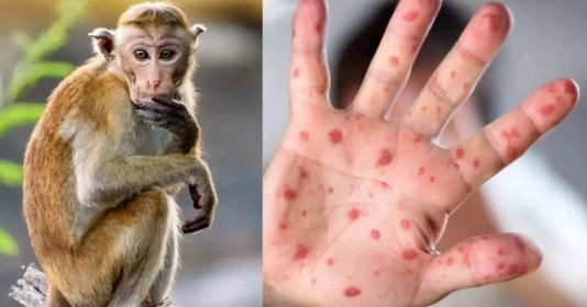 TP.HCM báo cáo ca bệnh đậu mùa khỉ đầu tiên ở Việt Nam