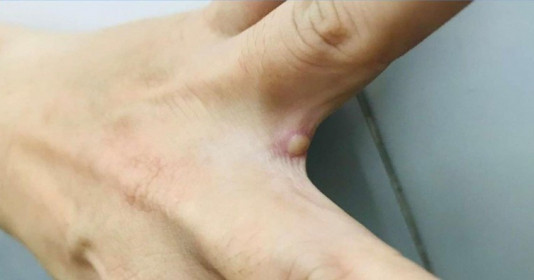 Người mắc đậu mùa khỉ đầu tiên ở Việt Nam đã xét nghiệm âm tính
