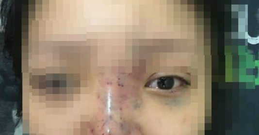 Cảnh báo biến chứng sau tiêm filler nâng ngực, mũi, mông...